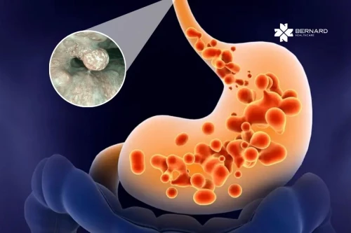 Từ đau bụng, khó tiêu, trào ngược,... đến tổn thương vùng thanh quản - Chớ chủ quan với những triệu chứng tiêu hóa kéo dài!